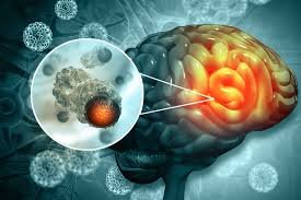 Advancements in Brain Cancer Treatment